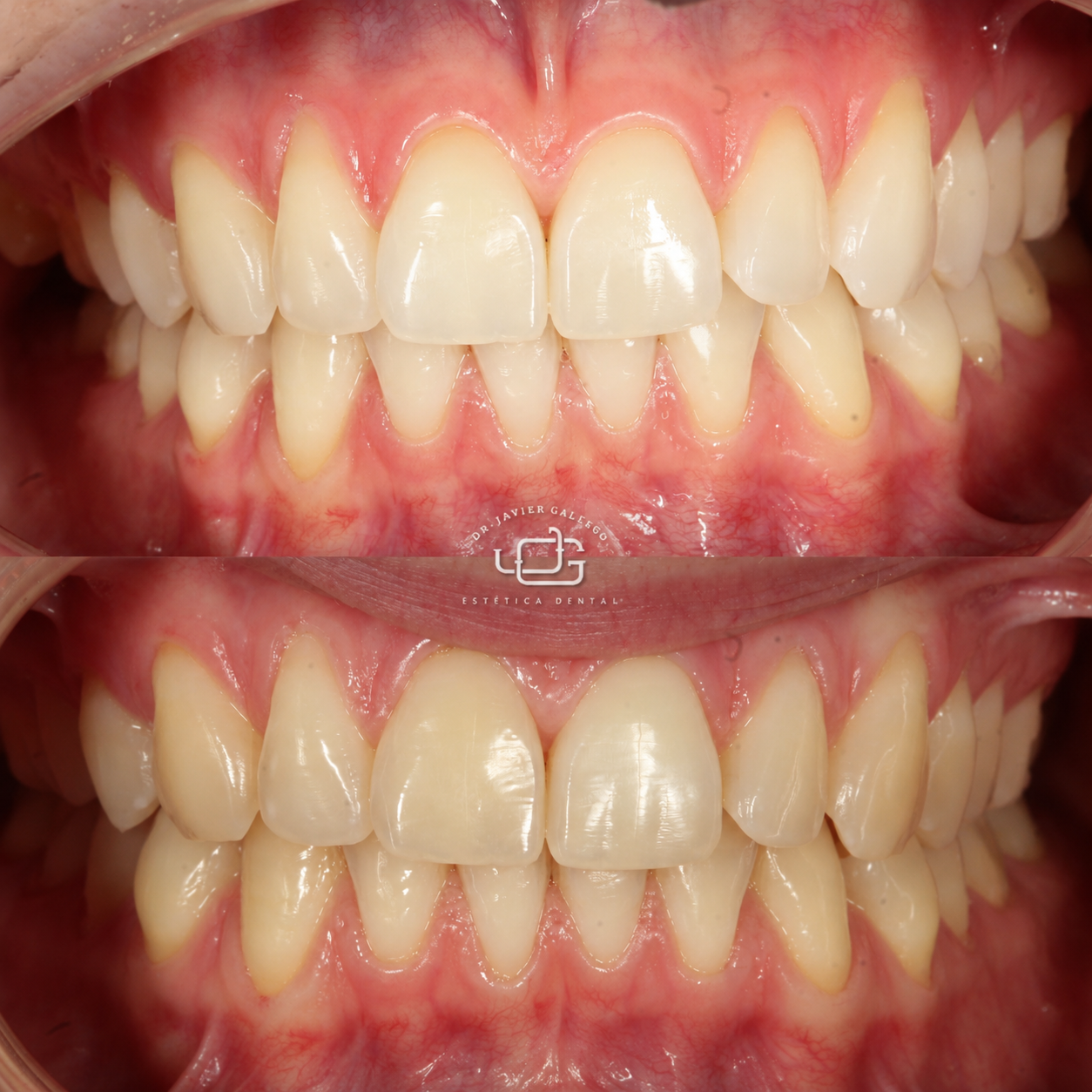 Caso de blanqueamiento dental, antes y después