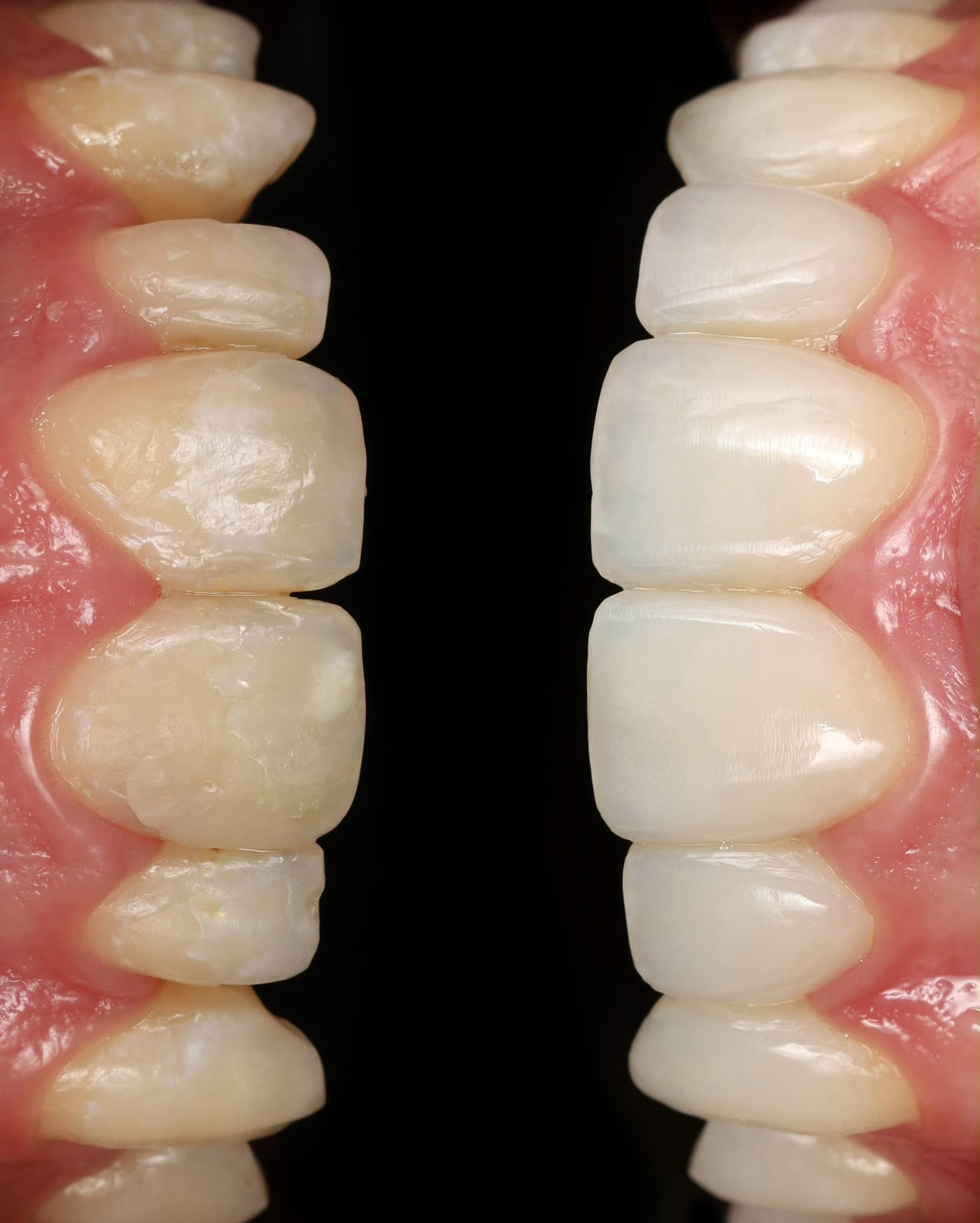 Caso de estética dental 1