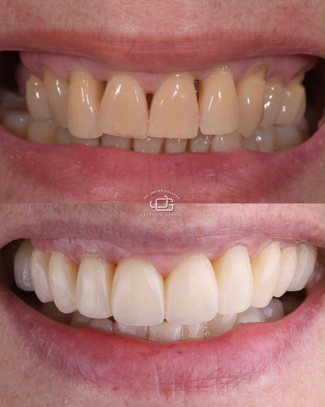 Caso de estética dental 2