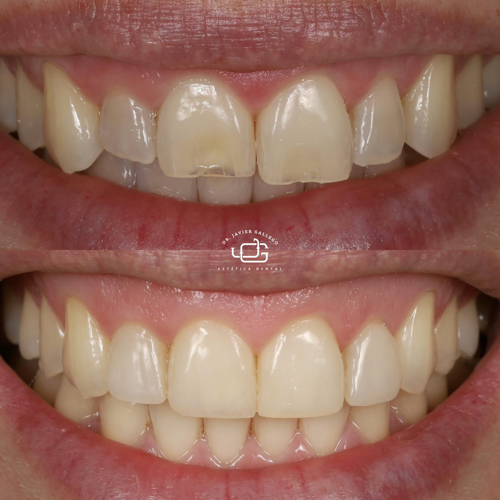 Caso de estética dental 3