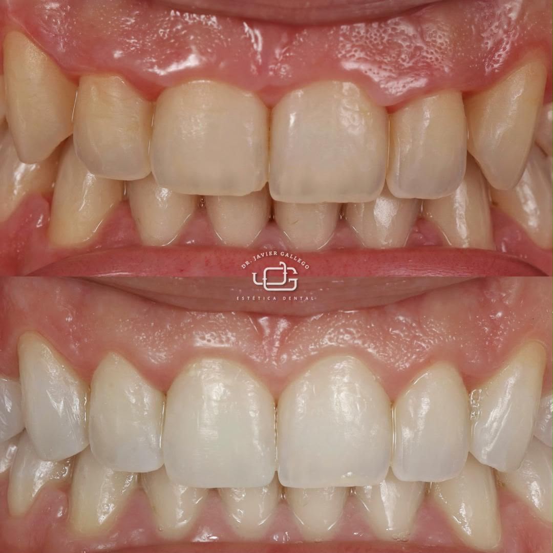 Caso de estética dental 4