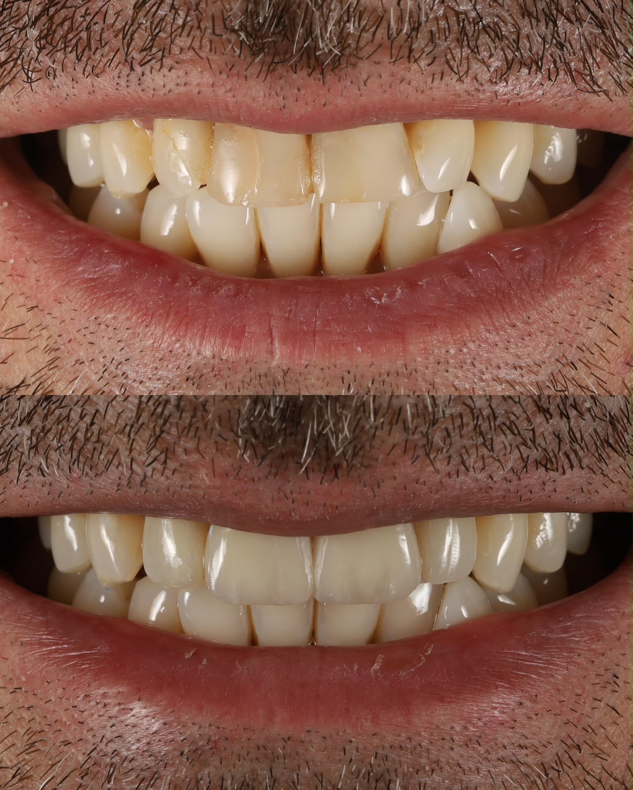Caso de estética dental 6