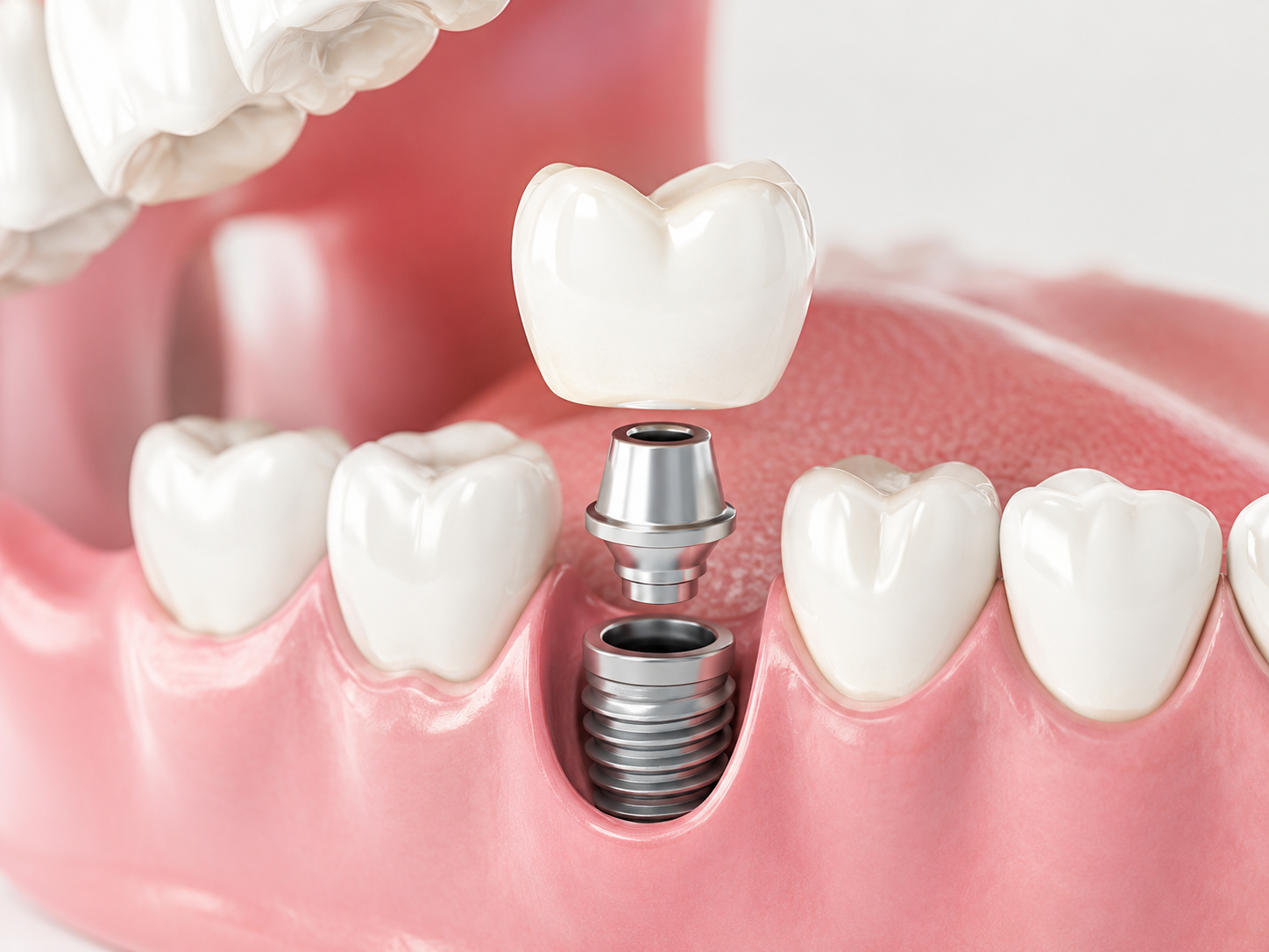 Tratamiento de implantes dentales
